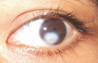vl-corneal-ulcer